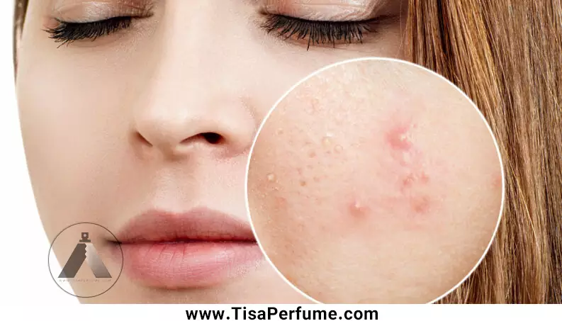 بهترین روش از بین بردن جای جوش