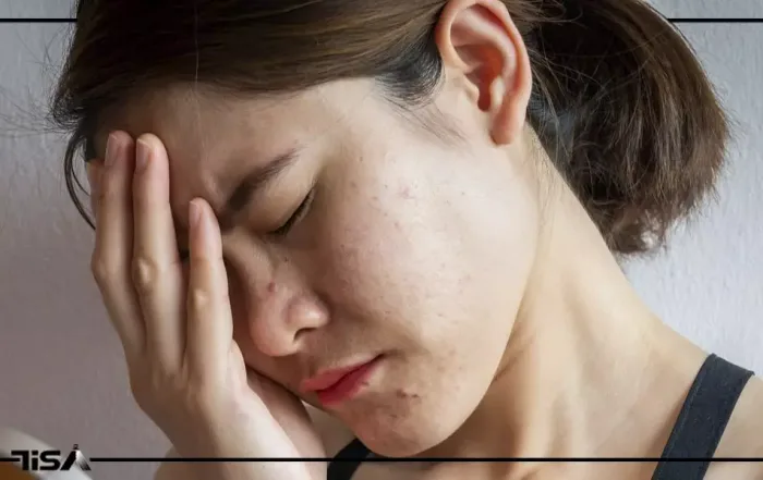 استرس و پوست حساس