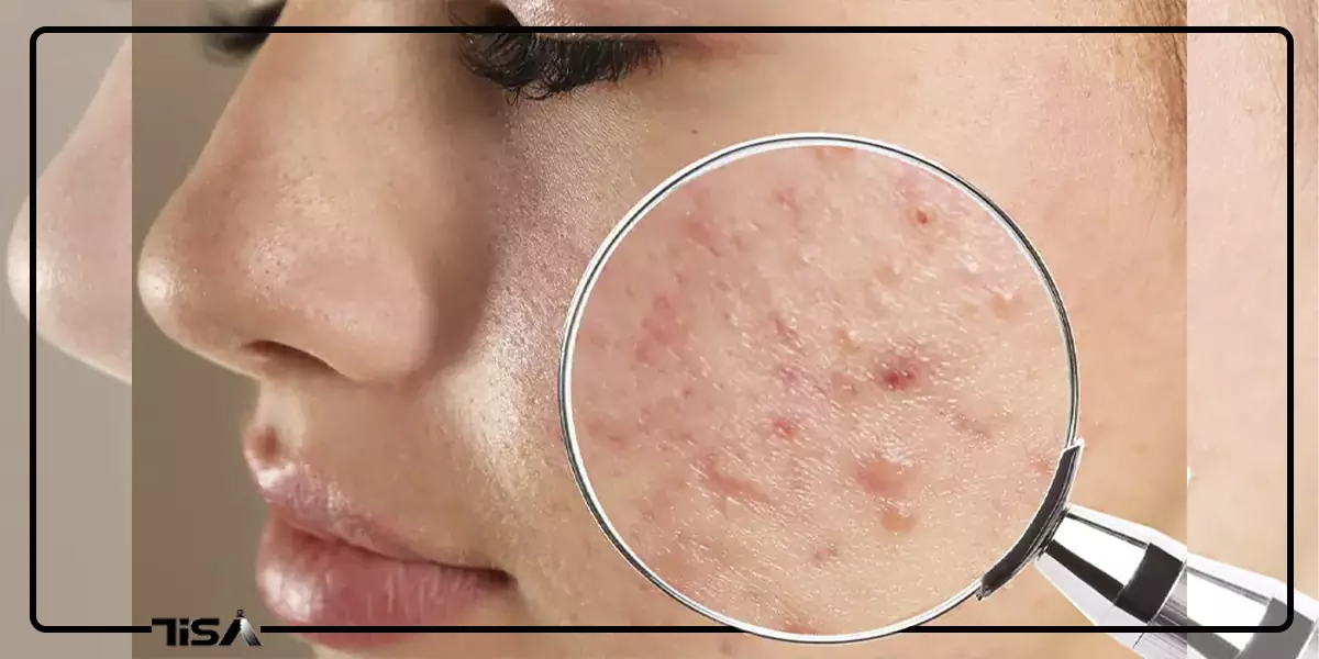 بهترین روش از بین بردن جای جوش